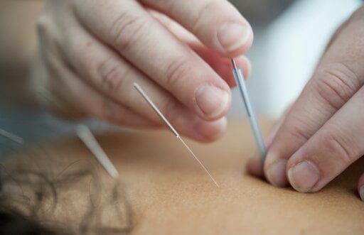 Acupuncture For Anxiety Near Me